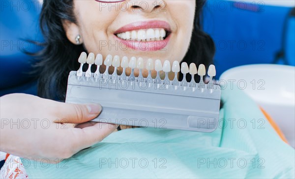 Cosmetological teeth whitening in a dental clinic