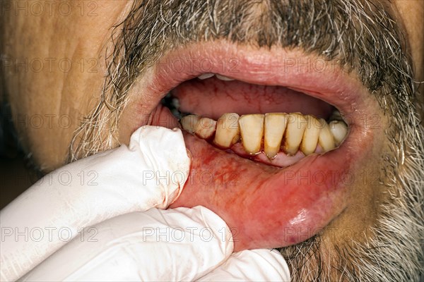 Symbolic image for periodontitis