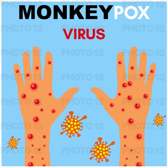 Monkeypox virus Illustration