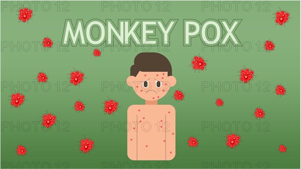 Monkeypox concept