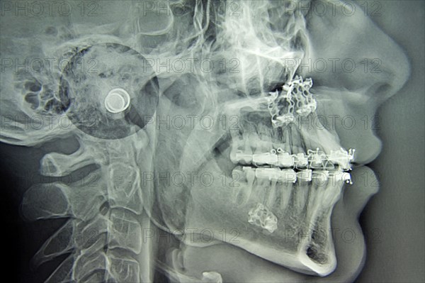 An X-ray of Maxillofacial Surgery