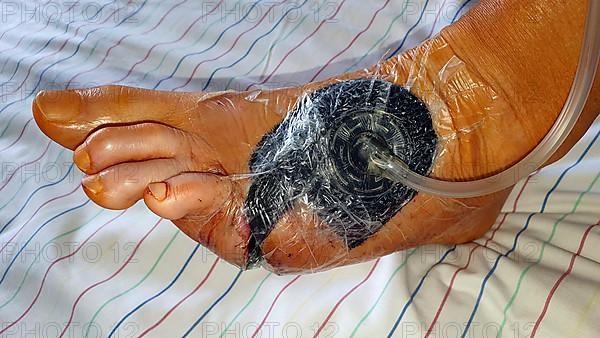 Vacuum therapy after surgery for diabetic foot syndrome