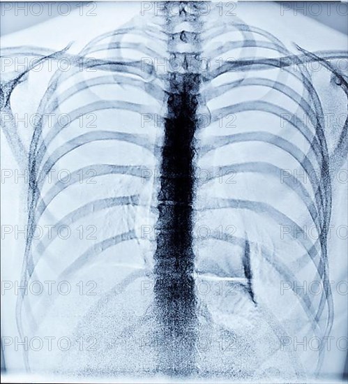 X-Ray Image Of Human Healthy Chest