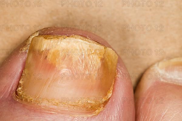 Nail fungus