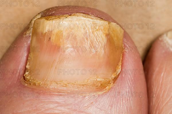 Nail fungus