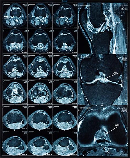 Magnetic resonance tomography