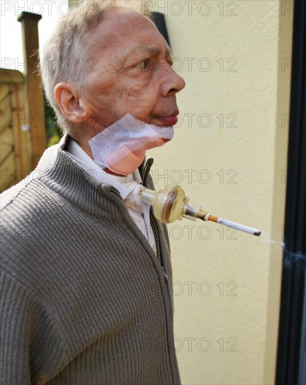 The Mother Theresa Hospice offers its guests a dignified home in a new friendly ambience for the patients in their last stage of life. This patient with carcinoma of the floor of the mouth caused by smoking and alcohol is 'allowed' to continue smoking