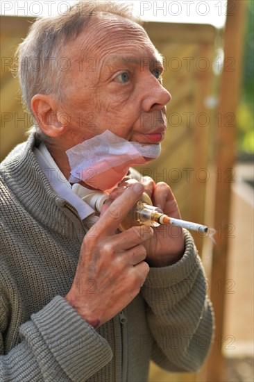 The Mother Theresa Hospice offers its guests a dignified home in a new friendly ambience for patients in their last phase of life. This patient with carcinoma of the floor of the mouth caused by smoking and alcohol is 'allowed' to continue smoking