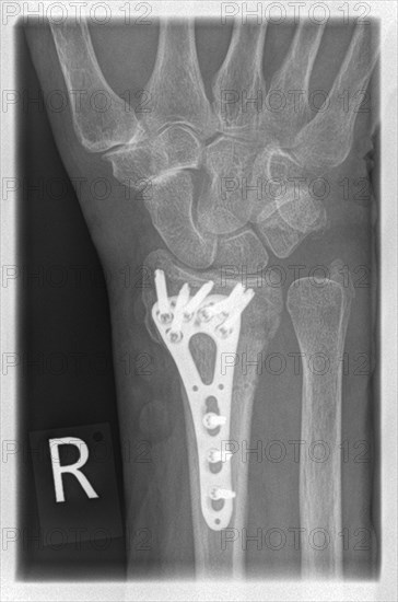 X-ray of a patient with a distal radial extension fracture on the right with PSU avulsion