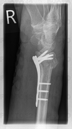 X-ray of a patient with a distal radial extension fracture on the right with PSU avulsion