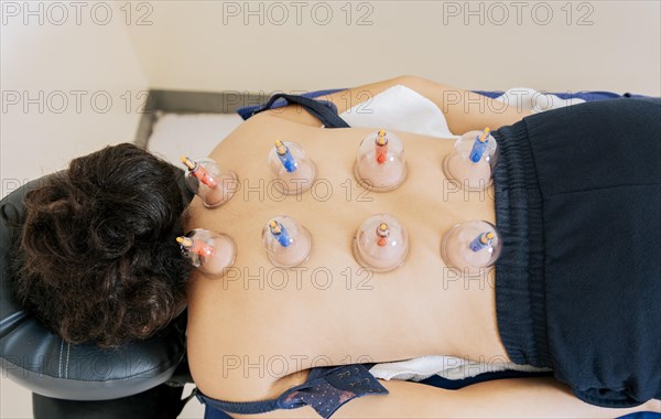 Patient lying down with suction cups on her back