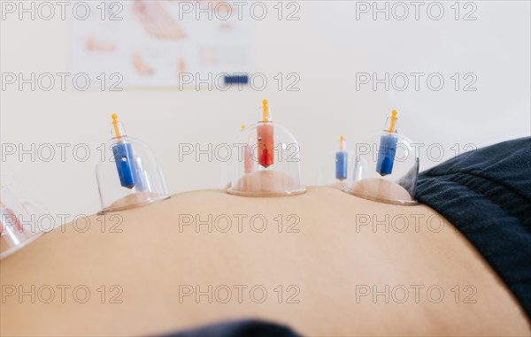 Close-up of suction cups on the patient back