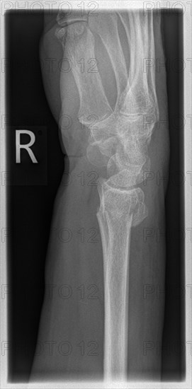 X-ray of a patient with a distal radial extension fracture on the right with PSU avulsion