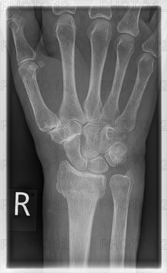 X-ray of a patient with a distal radial extension fracture on the right with PSU avulsion