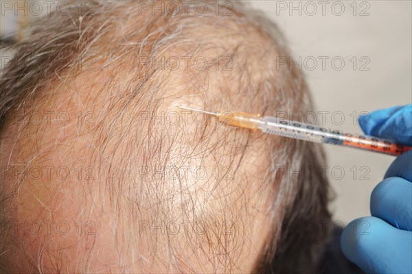 Hair transplantation, hair follicle transplantation, treatment of baldness and strengthening the scalp