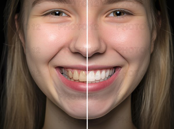 Young adult girl showing her beautiful before and after teeth whitening smile