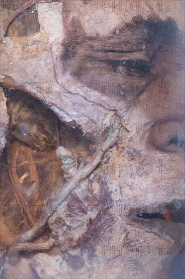 Closeup of a dead man's head preserved in a glass jar