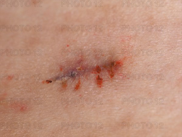 Surgical wound stitches removed