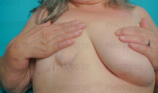 Nude woman seen from the front showing her scar from a mastectomy operation for breast cancer with a blue background