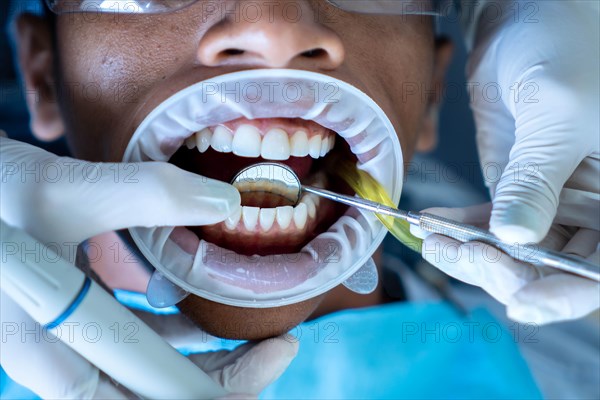 Closeup of rubber mouth opener on the patient in the dental office. Concept of whitening