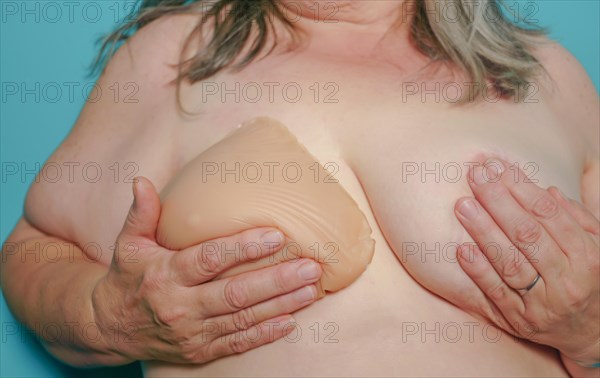 Frontal view of a woman with breast prosthesis after mastectomy surgery for breast cancer