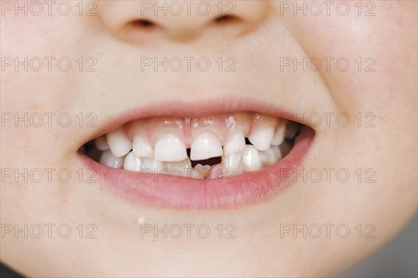 Symbolic photo on the subject of gaps between teeth. A five-year-old boy shows his tooth gap. Berlin