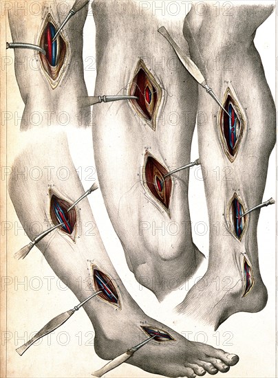 Four illustrations showing cuts in the leg and foot