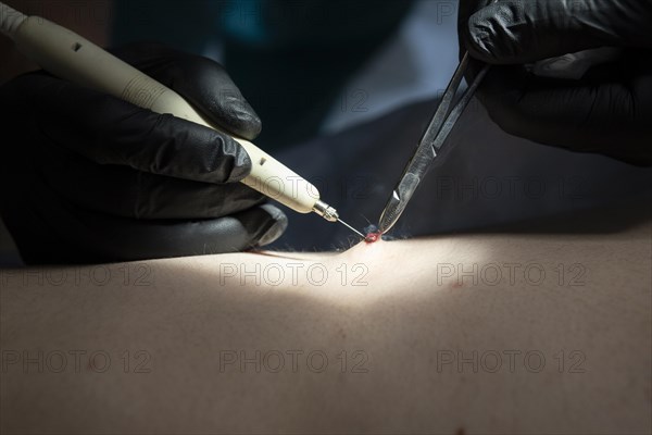 Doctor performing surgery for mole removal