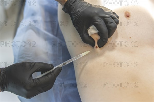 Doctor performing surgery for mole removal