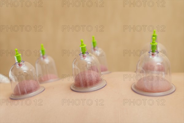 Close up patient experiencing cupping therapy