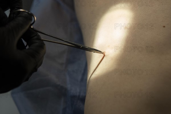 Doctor performing surgery for mole removal