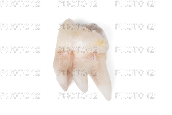 Pulled wisdom tooth