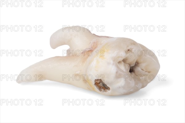 Pulled wisdom tooth