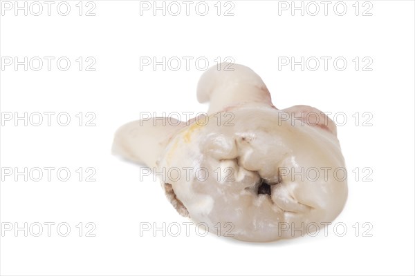 Pulled wisdom tooth