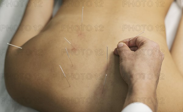 Acupuncture process close up