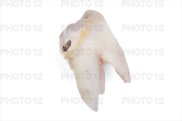 Pulled wisdom tooth