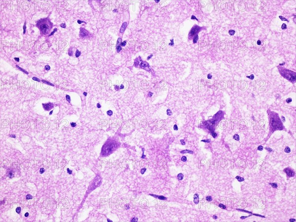 Histology of Human Brain Tissue Viewed at 400x Magnification with Haemotoxylin and Eosin Staining