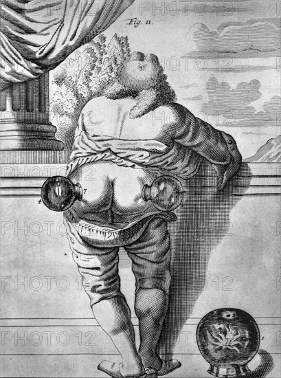 Illustration in the 1693 medical textbook Exercitationes practicae by Dutch doctor Frederick Dekkers