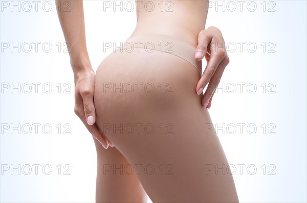 Image of female thighs with stretch marks on the skin. Laser correction.