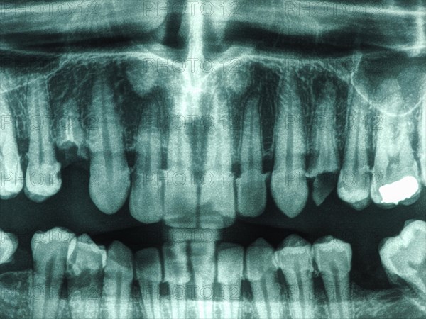 Human teeth xray