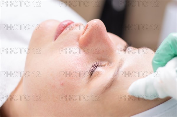 Portrait of a woman's face with problem skin. Peeling procedure. Natural beauty.