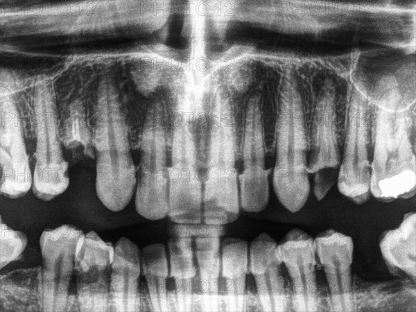 Human teeth xray in black and white