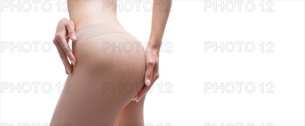 Image of female thighs with stretch marks on the skin. Laser correction.