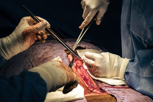 Close up of surgeons hands with scalpel at operation in operating room at hospital. Scoliosis surgery