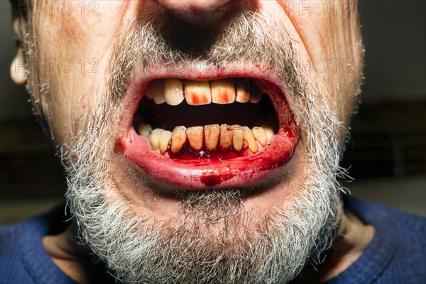 Symbol photo for aggression, Dracula, violence, brawl, injury and tantrum, an elderly man with a grey beard, bloodstained mouth, bloody gums and teeth