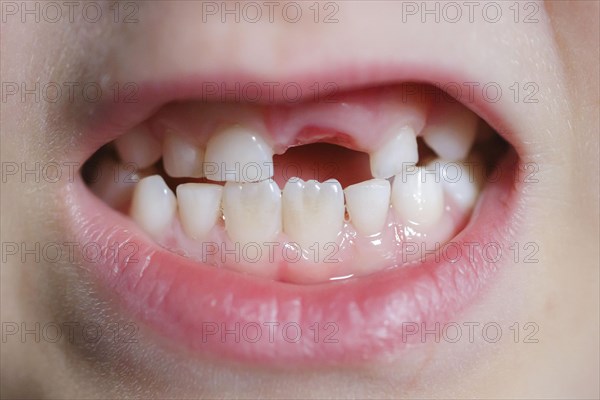 Symbolic photo on the subject of milk teeth. A six-year-old boy shows his teeth with a gap. Berlin, 07.03.2024