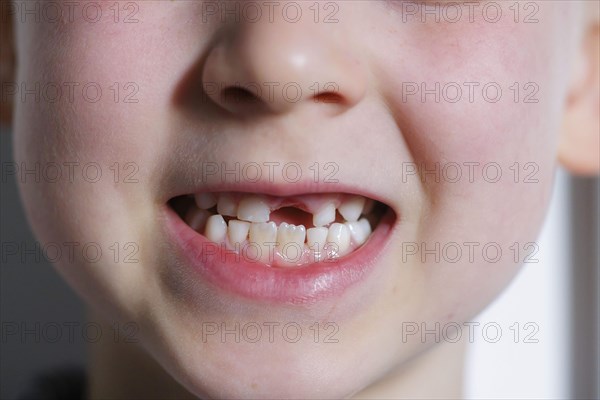 Symbolic photo on the subject of milk teeth. A six-year-old boy shows his teeth with a gap. Berlin, 07.03.2024