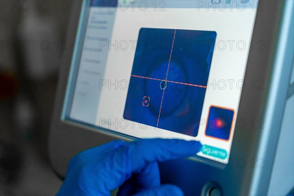 Screen used by the ophthalmologist to monitor the eye for laser application during glaucoma treatment in a patient