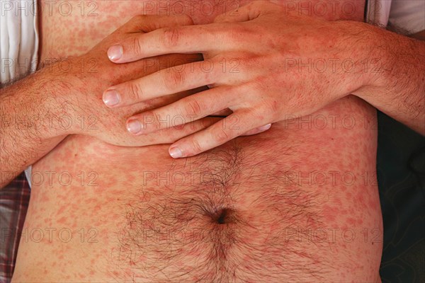 Measles or rubeola rash on Caucasian man's skin
