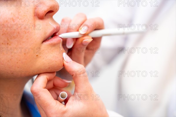 Aesthetic doctor marking the points of the lips to inject with hyaluronic acid